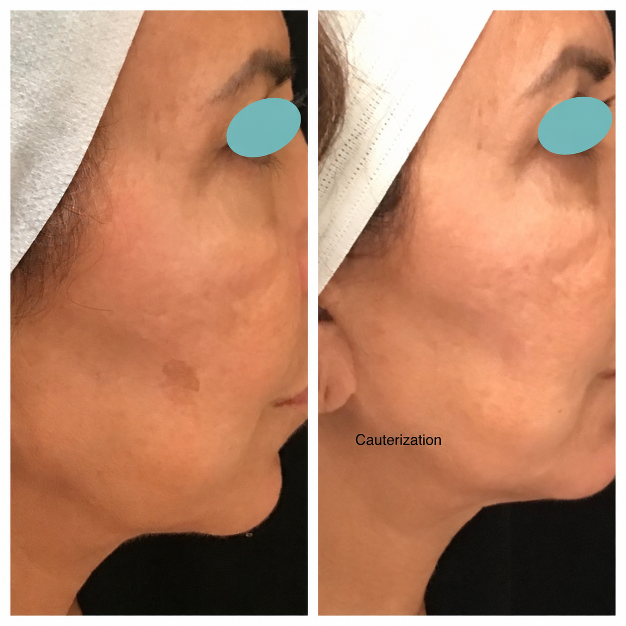 Before and after comparison: Cauterization. Eyes masked.