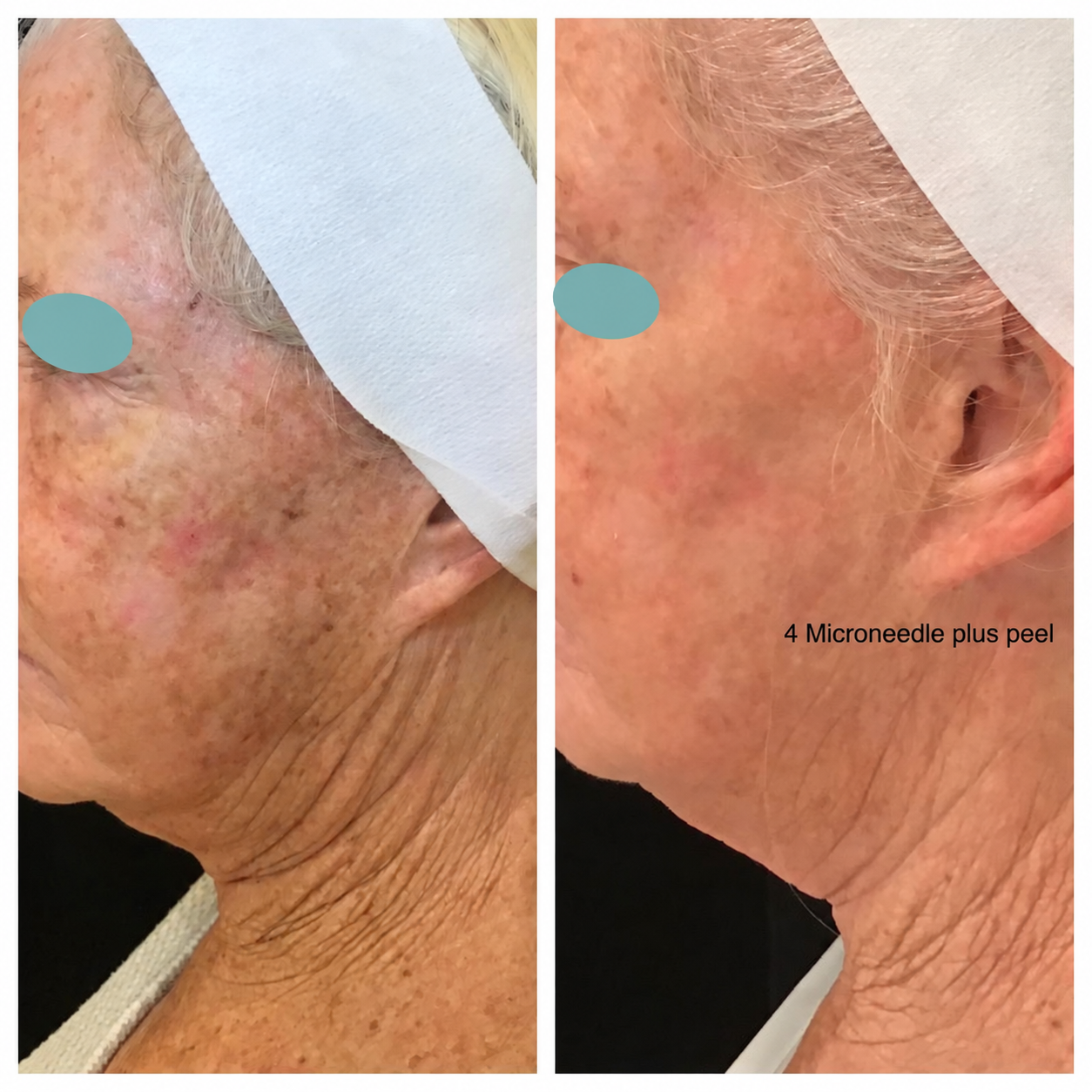 Before and after comparison: 4 Microneedle plus peel. Eyes masked.