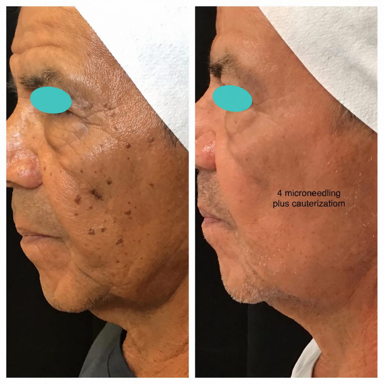 Before and after comparison: 4 microneedling plus cauterization. Eyes masked.