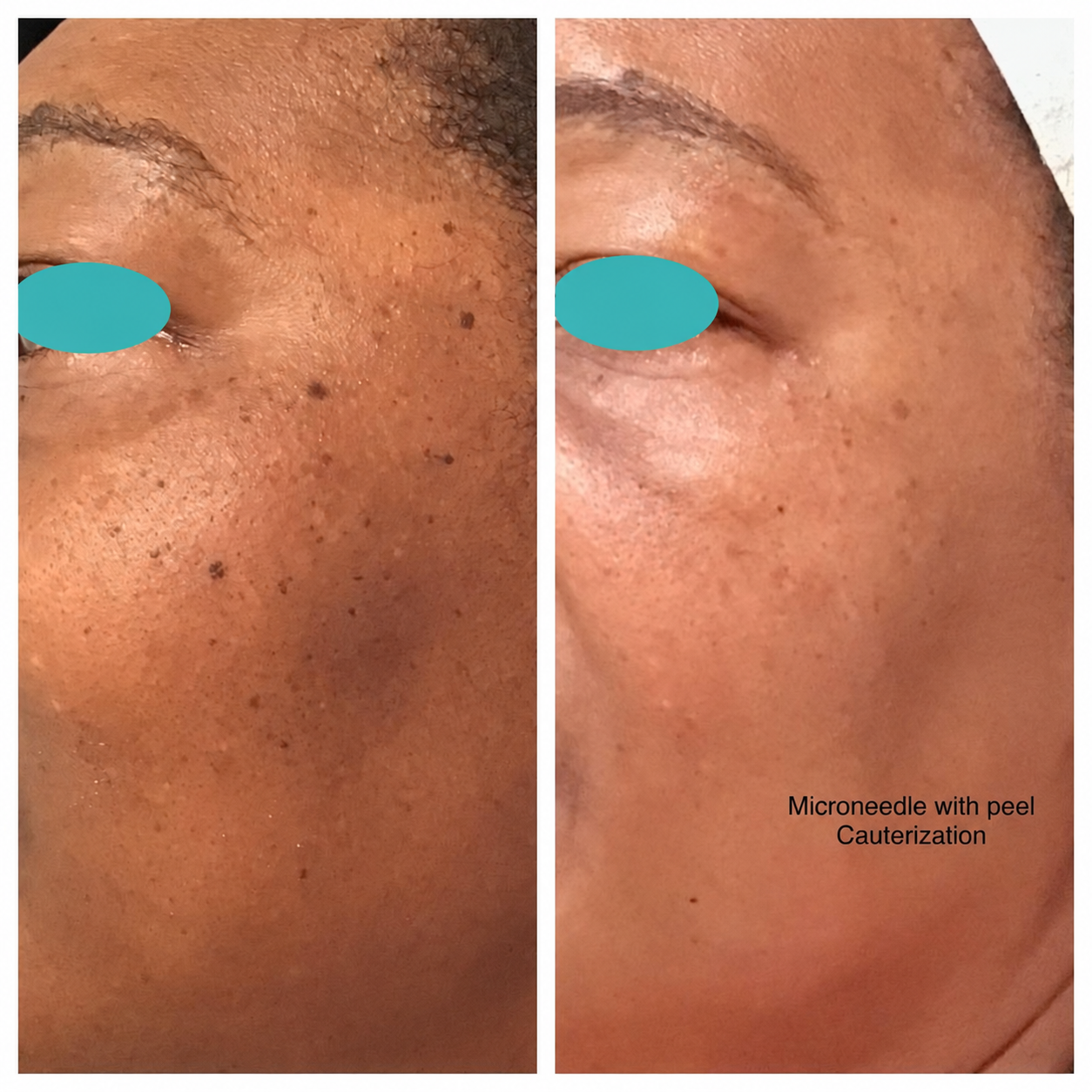 Before and after comparison: Microneedle with peel · Cauterization. Eyes masked.