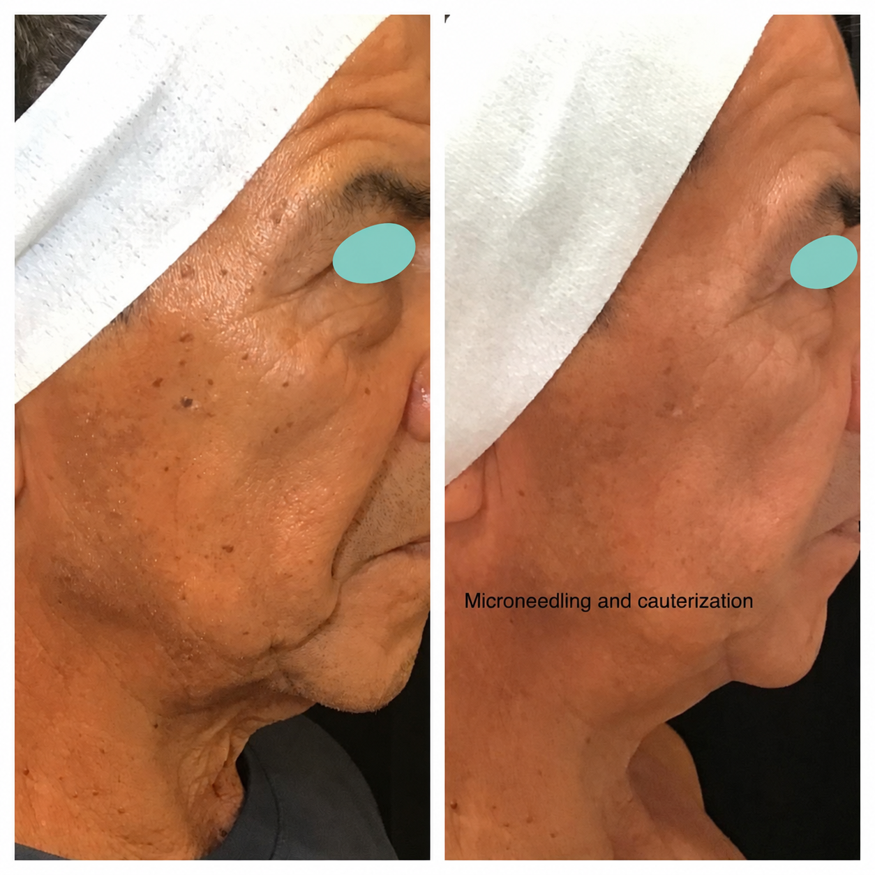 Before and after comparison: Microneedling and cauterization. Eyes masked.