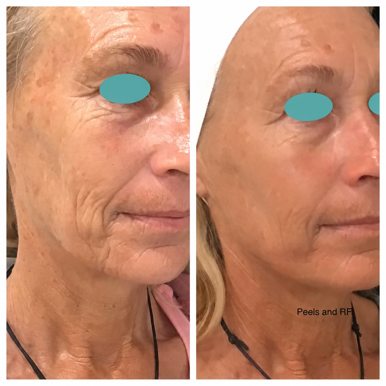 Before and after comparison: Peels and RF. Eyes masked.