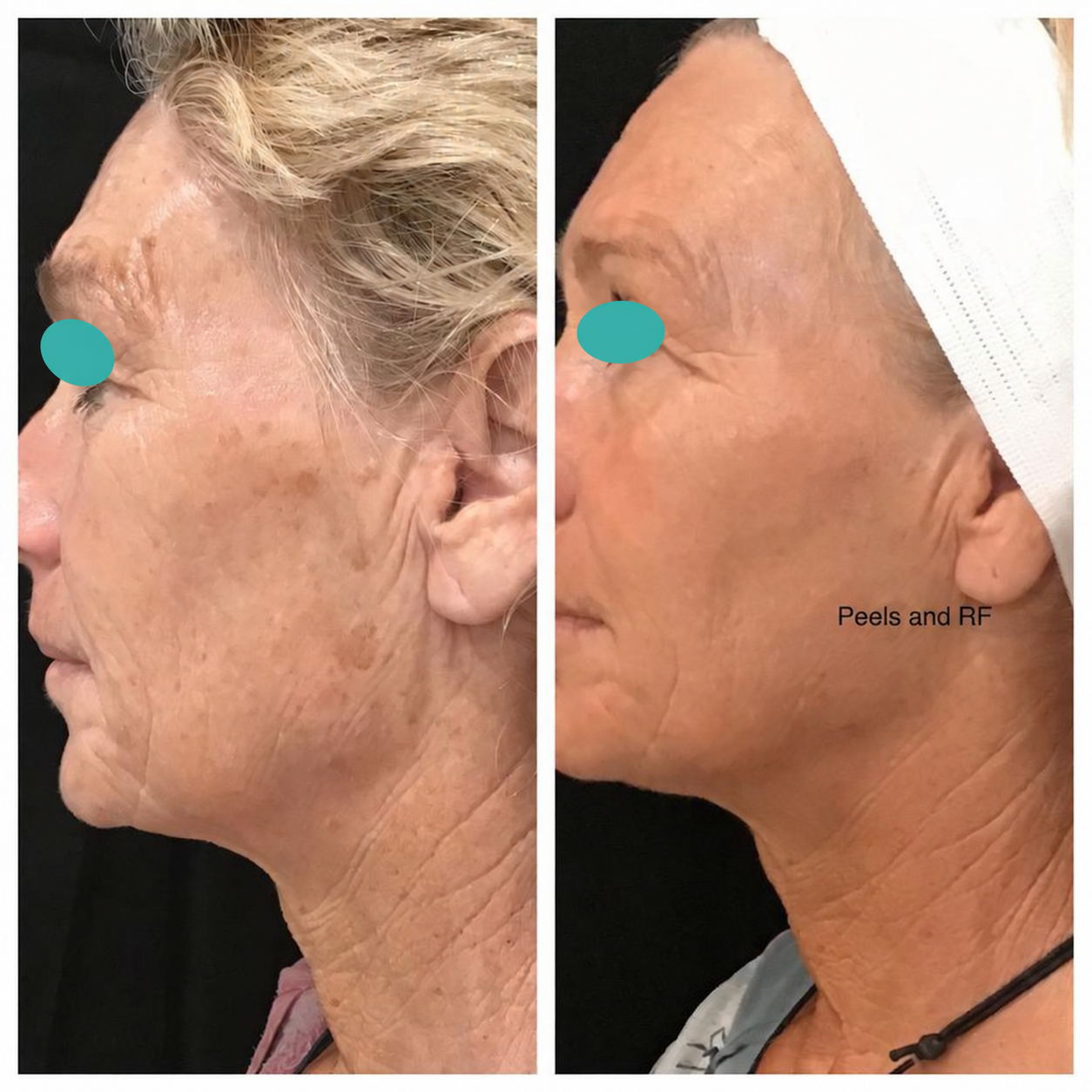 Before and after comparison: Peels and RF. Eyes masked.