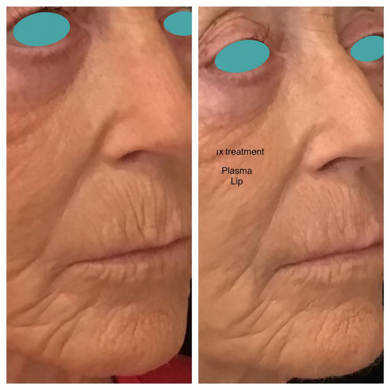 Before and after comparison: 1X treatment · Plasma Lip. Eyes masked.