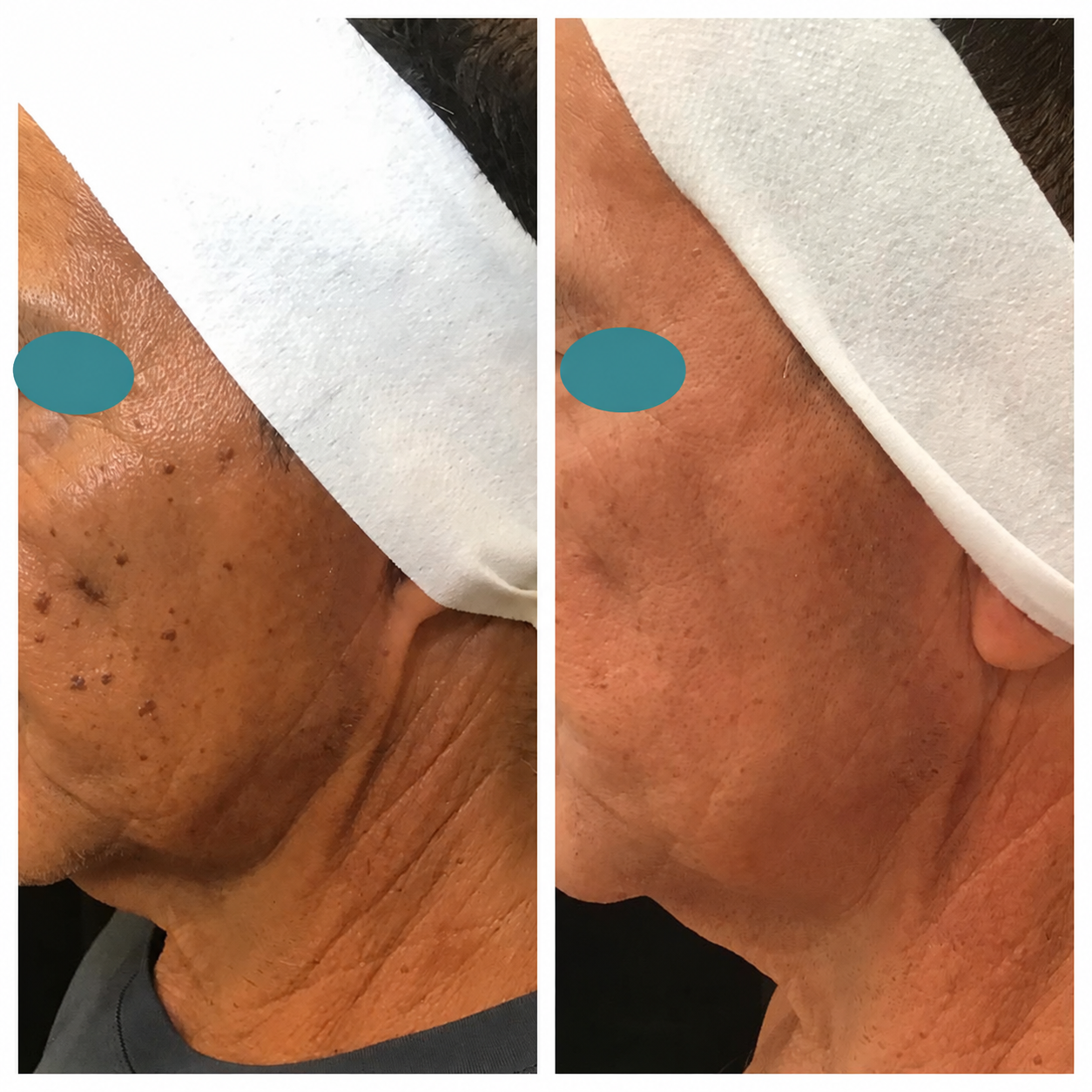 Before and after comparison: Treatment details not provided. Eyes masked.